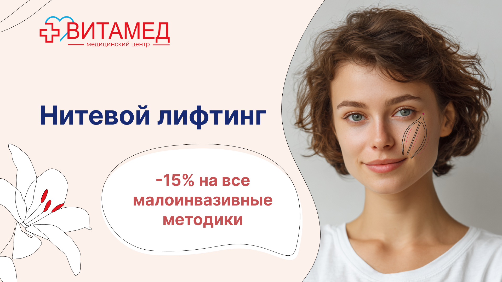 Нитевой лифтинг -15% на все малоинвазивные методики